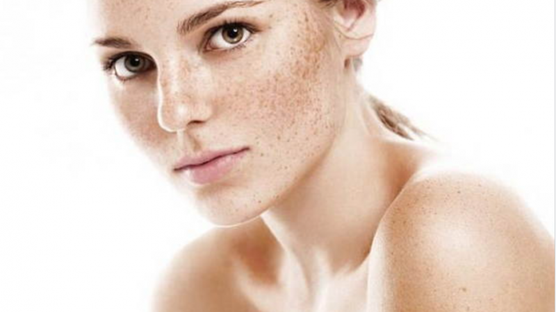 “Nám da” – nỗi ám ảnh với nhan sắc của phái đẹp và lời giải mang tên SB25 Collagen