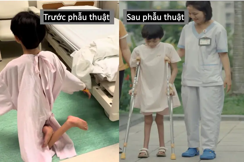 SAU 12 NĂM DI CHUYỂN BẰNG ĐẦU GỐI: BÉ GÁI LẦN ĐẦU ĐƯỢC ĐI BẰNG CHÍNH ĐÔI CHÂN MÌNH